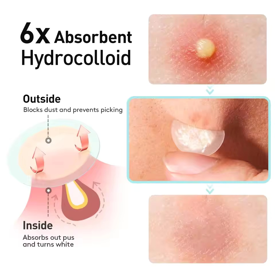 360 Stück/Karton Akne-Pflaster – Essential Oils Bewertung und Preis